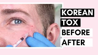 Korean Botulinum Toxin Before amp After  How To Dilute Toxins And Use For Forehead And Crow’s Feet [upl. by Renato64]