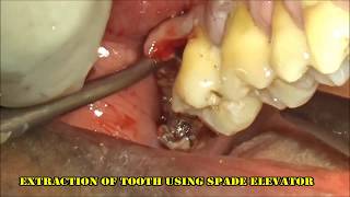 Severely infected upper right 3rd molar extraction [upl. by Kristel240]