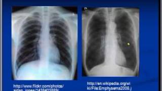 Chest xray interpretation COPD and Emphysema [upl. by Combs84]