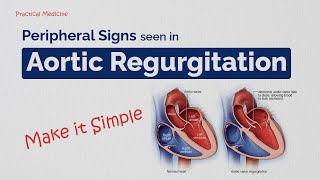 Making Bedside Diagnosis Easy Peripheral Signs in Aortic Regurgitation [upl. by Luciana]