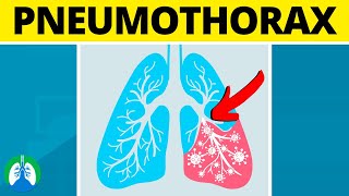 Pneumothorax Medical Definition  Quick Explainer Video [upl. by Asilav]