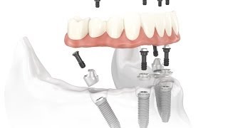 Dental Implant Osseointegration Process [upl. by Auguste]