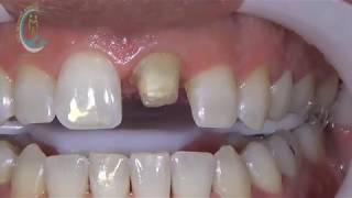 CORONA DE ZIRCONIO Alianza Dental Mx ® [upl. by Mozart]