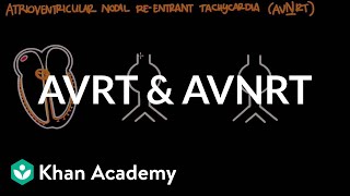 Atrioventricular reentrant tachycardia AVRT amp AV nodal reentrant tachycardia AVNRT [upl. by Raclima]