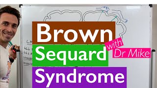 Brown Sequard Syndrome [upl. by Ekud]