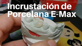 INCRUSTACIÓN Dental de Porcelana👅 EMax Onlay dentaltip [upl. by Airdnoed]