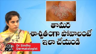 తామర శాశ్వతంగా పోవాలంటే ఇలా చేయండి  Best Treatment For Tamara Skin Disease In Telugu  Leo Health [upl. by Nylasoj]