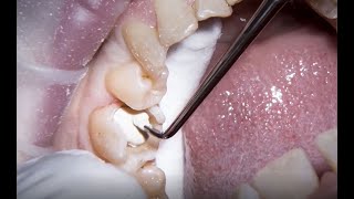 Treating secondary caries with Biodentine by Dr Nicola Bone [upl. by Hali]