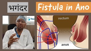 Fistula in Ano  in Hindi [upl. by Ahsenad291]