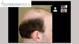 Best Hair Transplant Procedure His Barber Has Ever Seen  Dr Blumenthal David [upl. by Loutitia528]