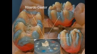 CERAMICA SOBRE CIRCONIO PASO A PASO [upl. by Sonaj]