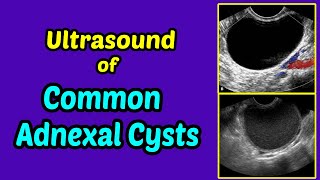 Ultrasound of Common Adnexal Cysts [upl. by Ramalahs]