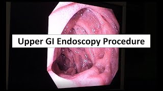 Upper GI Endoscopy Procedure in the ED [upl. by Arzed568]