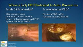 Management of Acute Pancreatitis [upl. by Jumbala]