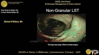 The large polyp When to choose EMR ESD surgery [upl. by Ayor290]