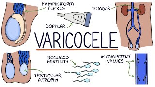 Varicocele Surgery What to Expect [upl. by Nosirb]