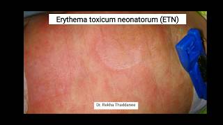 Erythema Toxicum Neonatorum  Pediatrics [upl. by Aniretak]