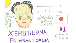 Xeroderma Pigmentosum [upl. by Retse]