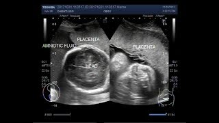 Ultrasound Video showing Polyhydramnios and other fetal anomalies [upl. by Eveline]