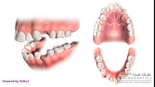 4 First Premolar Extraction for Retraction  Orthodontic Treatment [upl. by Martguerita]