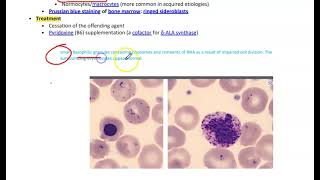 Sideroblastic AnemiaMicrocytic Anemia [upl. by Silvano]