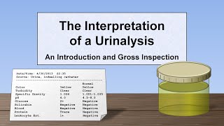 Urothelial carcinoma  urinary system pathology [upl. by Ennaylil]