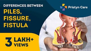 Differences Between Piles Fissures and Fistula in Tamil  For Free Appointment Call on 6366526460 [upl. by Phi846]