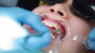 Braces Putting Braces On Bonding Procedure  Aura Orthodontics [upl. by Inal]