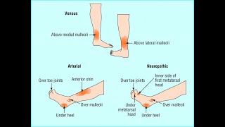 Ulcera cruris  Arterial amp Venous [upl. by Lejeune802]