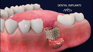 How to Perform Dental Implants by MIS Tutorial 3D Dental Animation [upl. by Anastasie875]