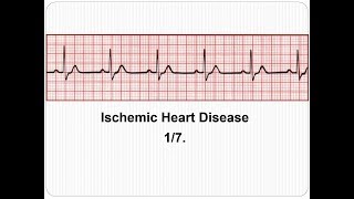 ECG Ischemic Heart Disease 17 Introduction [upl. by Trenton]