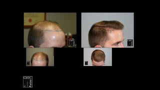 My Hair Transplant Results 6 Months  Surgeon Reacts [upl. by Wojcik]