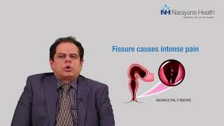 Piles Fissures amp Fistula Key Differences Explained by Dr Vikas Kapur [upl. by Fulks]