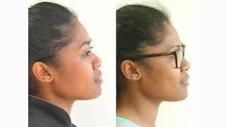 How Orthodontic Extractions can change Facial Profiles [upl. by Jeane]