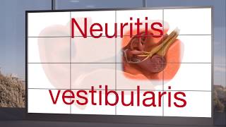 Neuritis vestibularis [upl. by Hildegarde]