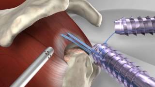 Knotless Rotator Cuff Repair with Arthrex® SpeedFix™ [upl. by Schreck]