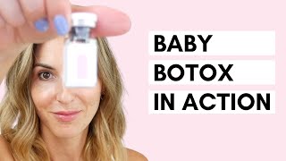 Baby Botox  Using a Dermastamp for Microneedling [upl. by Wolram564]